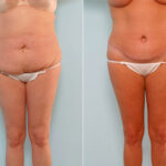 Abdominoplasty before and after photos in Houston, TX, Patient 24550