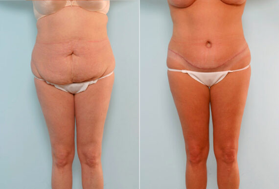 Tummy Tuck/Abdominoplasty before and after photos in Houston, TX, Patient 24550