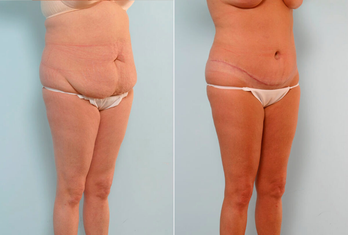 Abdominoplasty before and after photos in Houston, TX, Patient 24550