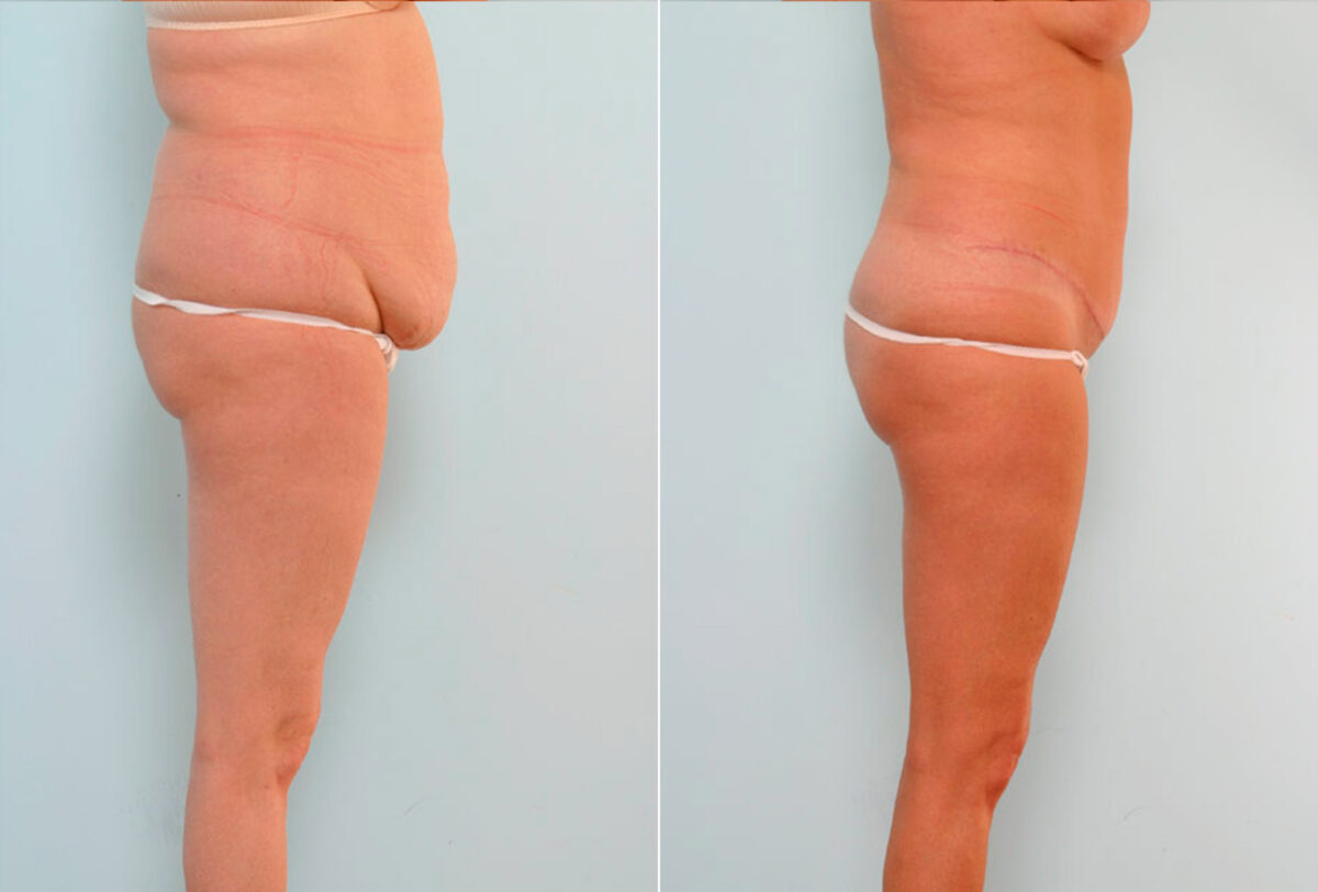 Abdominoplasty before and after photos in Houston, TX, Patient 24550