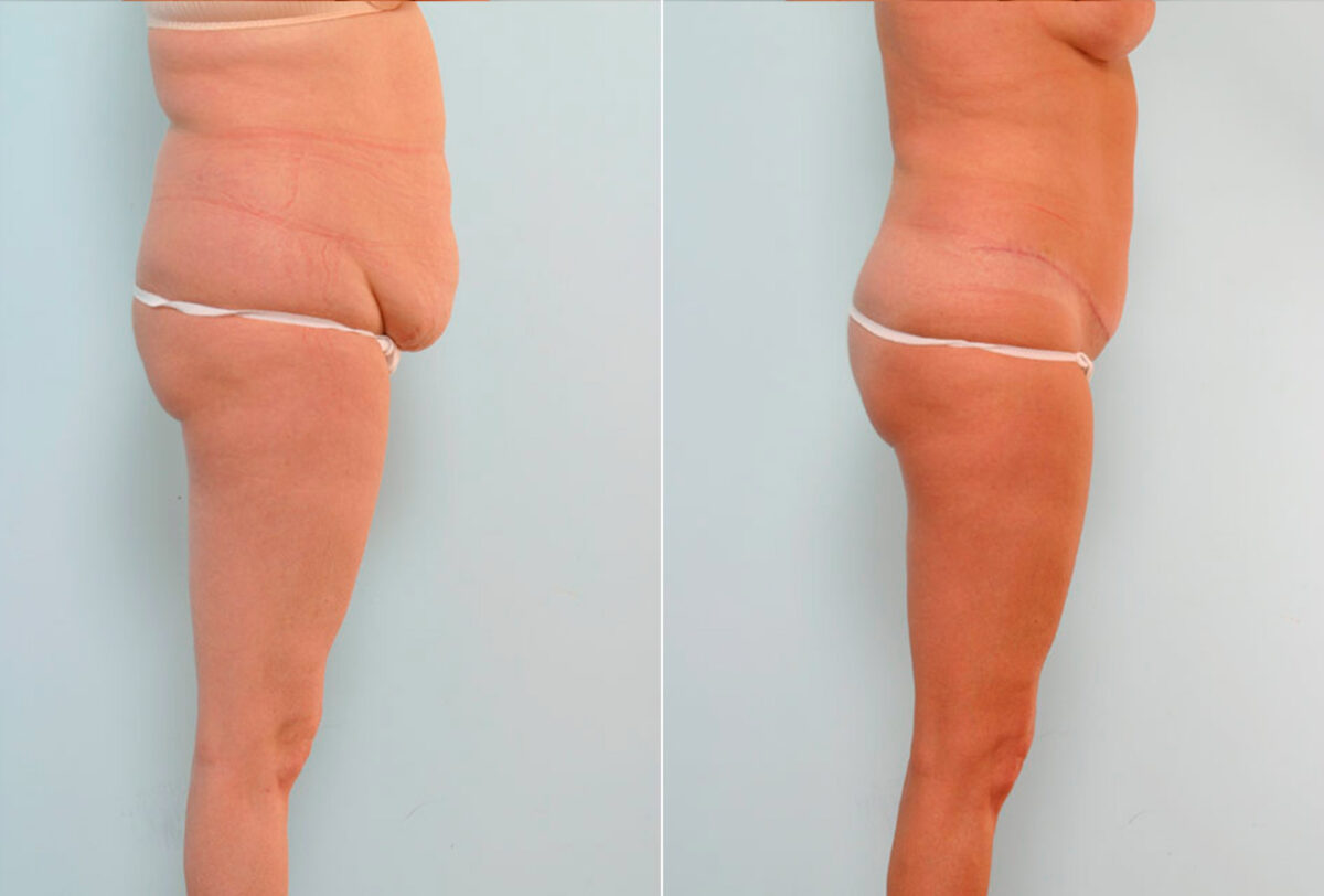Tummy Tuck/Abdominoplasty before and after photos in Houston, TX, Patient 24550