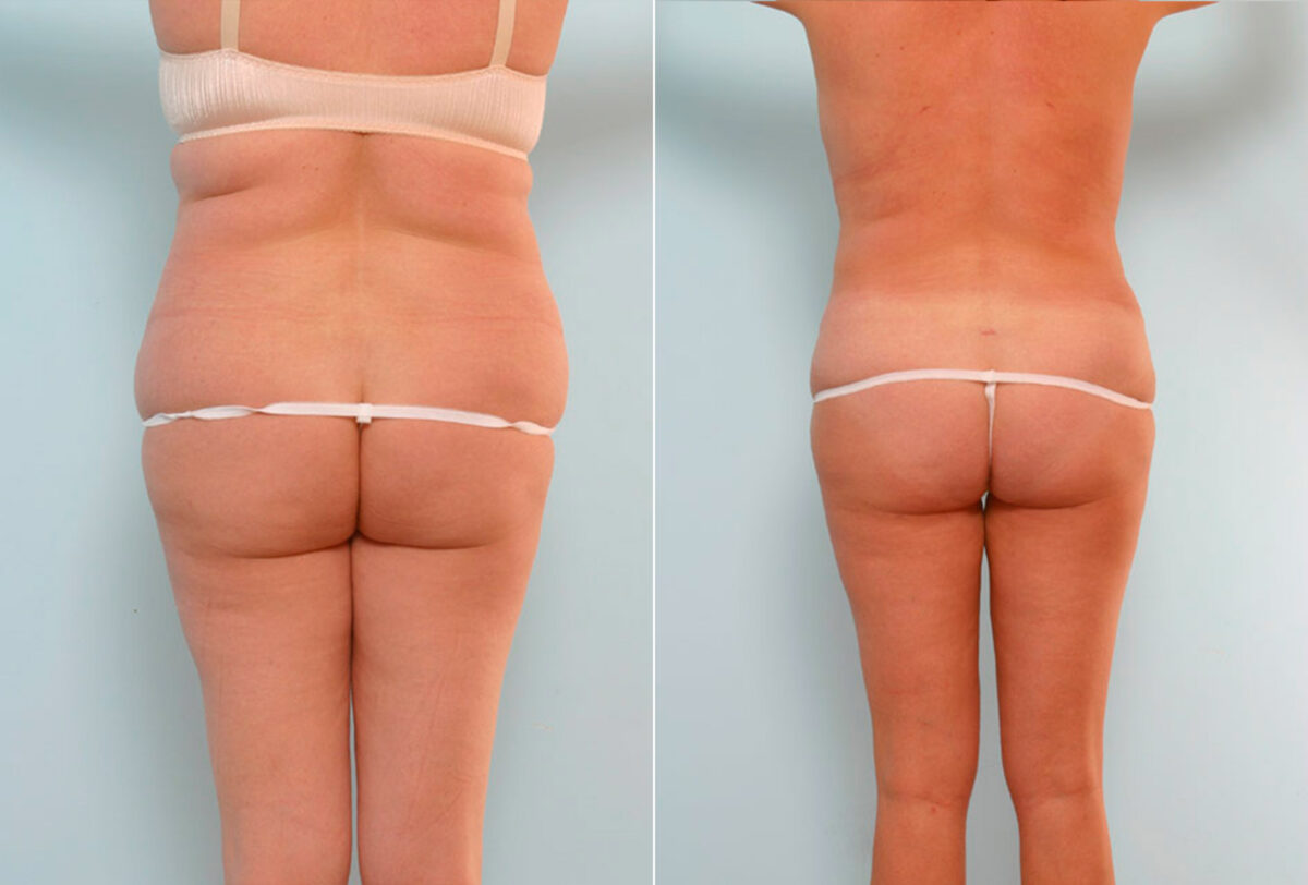 Abdominoplasty before and after photos in Houston, TX, Patient 24550