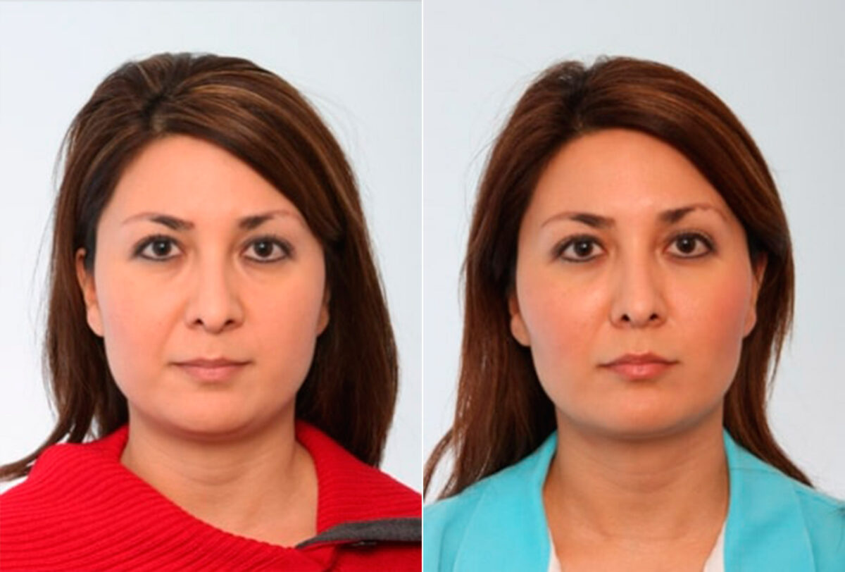 Buccal Fat Pad Removal before and after photos in Houston, TX, Patient 27765