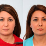 Buccal Fat Pad Removal before and after photos in Houston, TX, Patient 27765