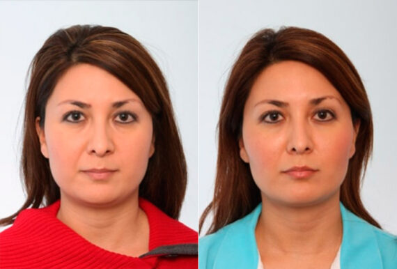 Buccal Fat Pad Removal before and after photos in Houston, TX