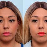 Buccal Fat Pad Removal before and after photos in Houston, TX, Patient 27775