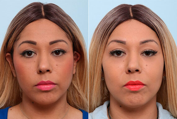 Buccal Fat Pad Removal before and after photos in Houston, TX