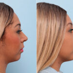 Buccal Fat Pad Removal before and after photos in Houston, TX, Patient 27775