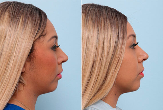 Buccal Fat Pad Removal before and after photos in Houston, TX, Patient 27775