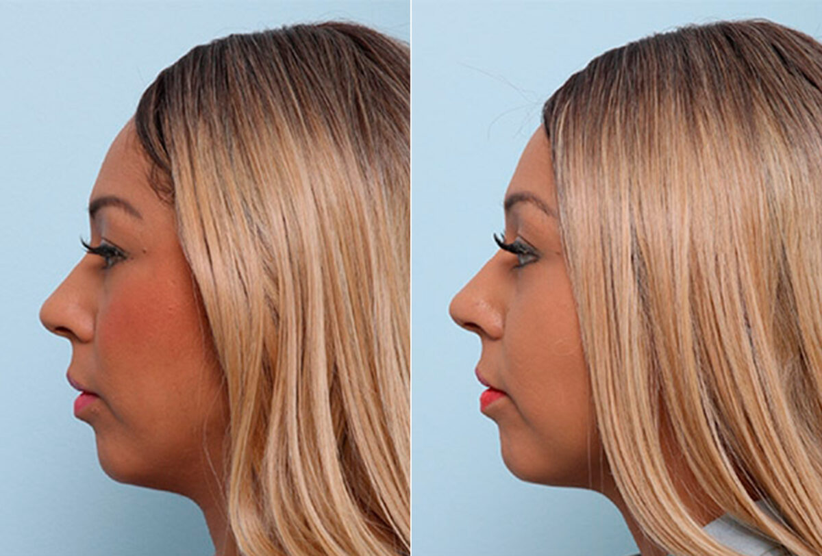 Buccal Fat Pad Removal before and after photos in Houston, TX, Patient 27775