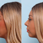 Buccal Fat Pad Removal before and after photos in Houston, TX, Patient 27775