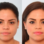 Buccal Fat Pad Removal before and after photos in Houston, TX, Patient 27782