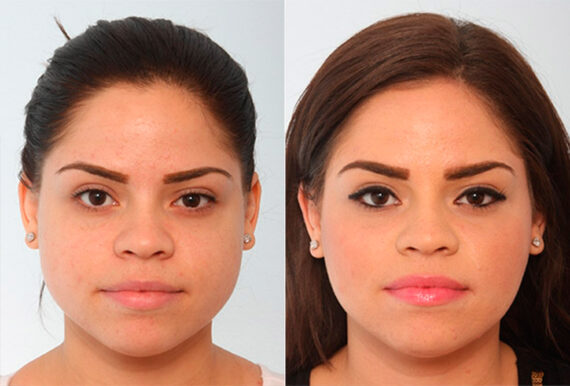 Buccal Fat Pad Removal before and after photos in Houston, TX, Patient 27782