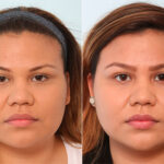 Buccal Fat Pad Removal before and after photos in Houston, TX, Patient 27789