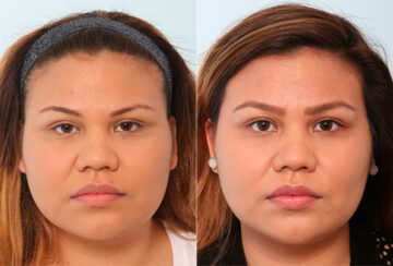 Buccal Fat Pad Removal before and after photos in Houston, TX, Patient 27789