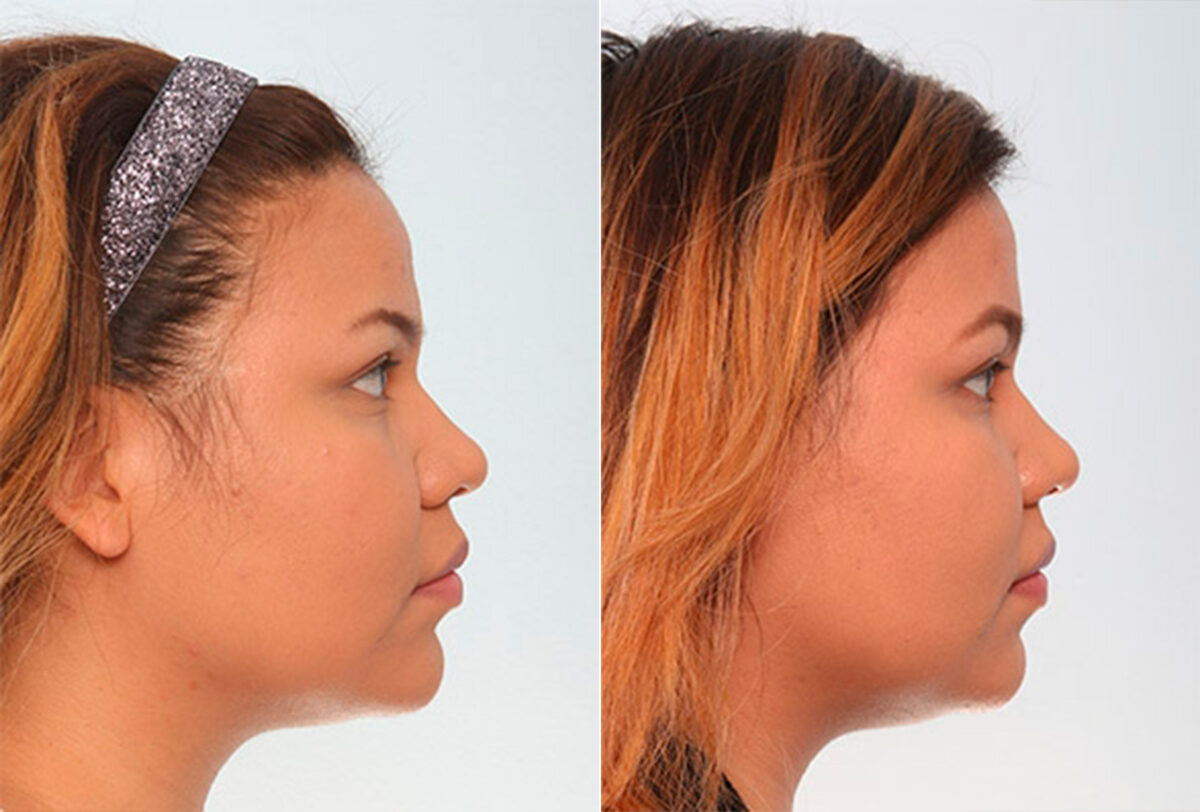 Buccal Fat Pad Removal before and after photos in Houston, TX, Patient 27789