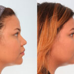 Buccal Fat Pad Removal before and after photos in Houston, TX, Patient 27789