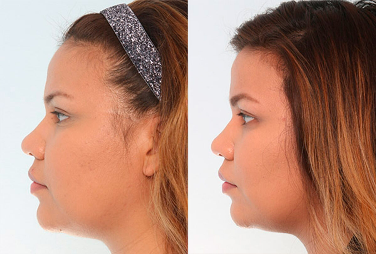 Buccal Fat Pad Removal before and after photos in Houston, TX, Patient 27789