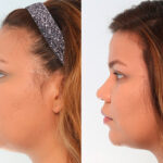 Buccal Fat Pad Removal before and after photos in Houston, TX, Patient 27789