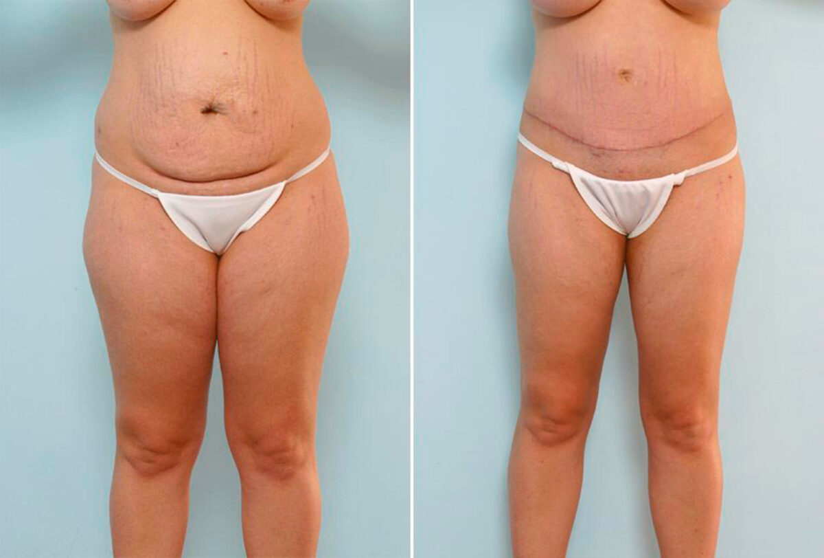 Tummy Tuck/Abdominoplasty before and after photos in Houston, TX, Patient 24559