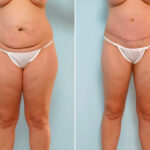 Abdominoplasty before and after photos in Houston, TX, Patient 24559