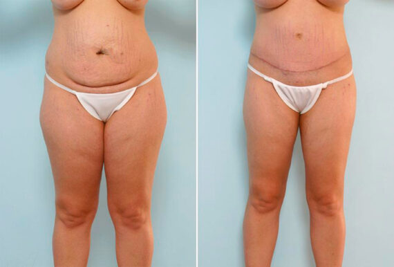 Abdominoplasty before and after photos in Houston, TX, Patient 24559