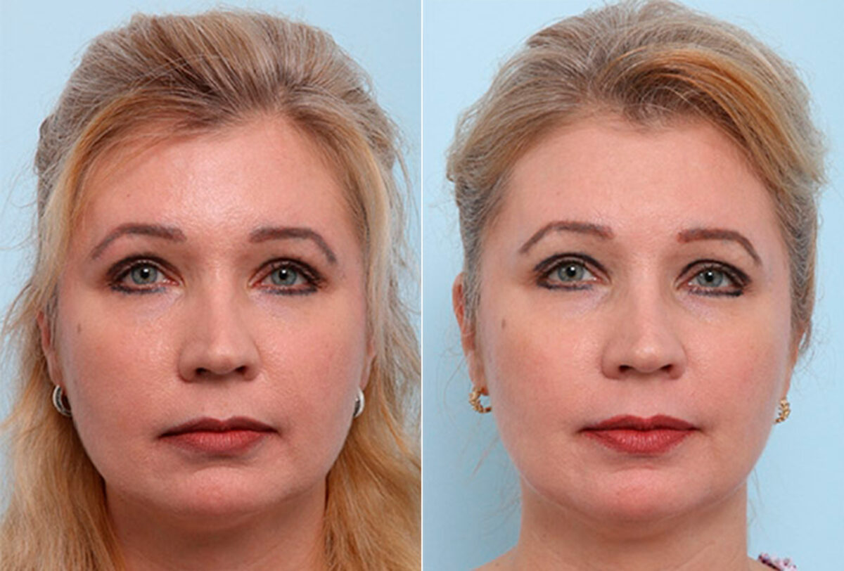 Buccal Fat Pad Removal Photos, Houston, Tx