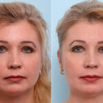 Buccal Fat Pad Removal before and after photos in Houston, TX, Patient 27796