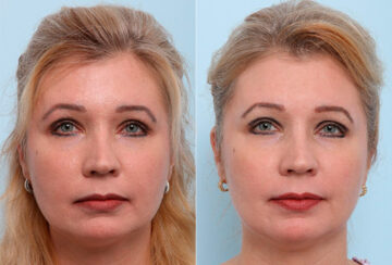 Buccal Fat Pad Removal before and after photos in Houston, TX, Patient 27796