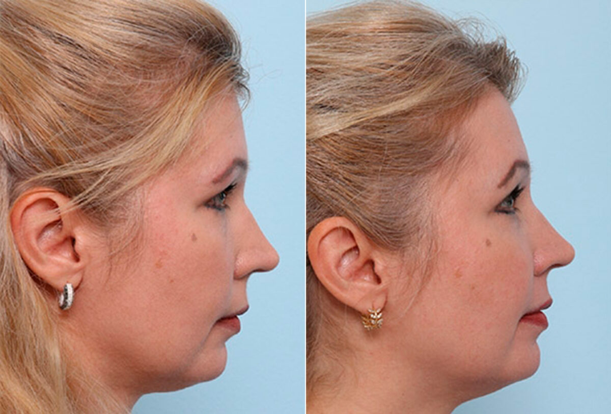 Buccal Fat Pad Removal before and after photos in Houston, TX, Patient 27796