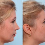 Buccal Fat Pad Removal before and after photos in Houston, TX, Patient 27796