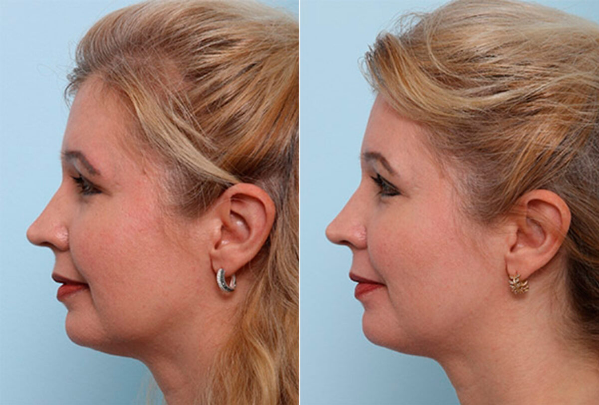 Buccal Fat Pad Removal before and after photos in Houston, TX, Patient 27796