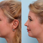 Buccal Fat Pad Removal before and after photos in Houston, TX, Patient 27796