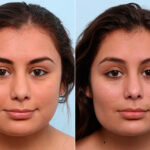 Buccal Fat Pad Removal before and after photos in Houston, TX, Patient 27803