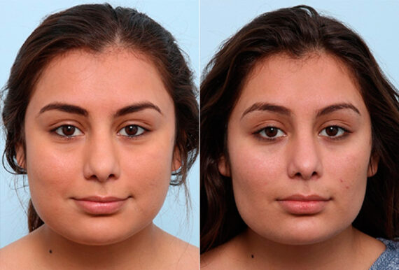 Buccal Fat Pad Removal before and after photos in Houston, TX, Patient 27803