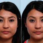 Buccal Fat Pad Removal before and after photos in Houston, TX, Patient 27817