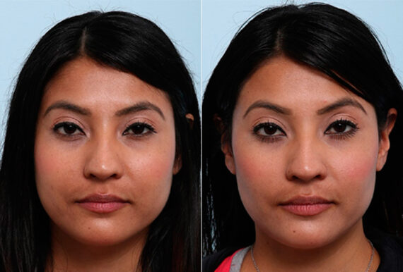 Buccal Fat Pad Removal before and after photos in Houston, TX, Patient 27817