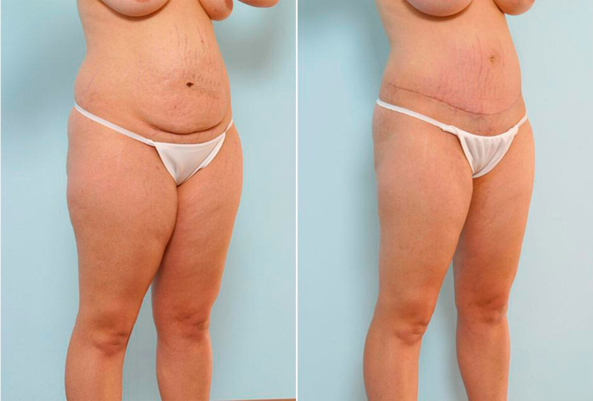 Tummy Tuck/Abdominoplasty before and after photos in Houston, TX, Patient 24559