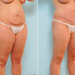 Abdominoplasty before and after photos in Houston, TX, Patient 24559