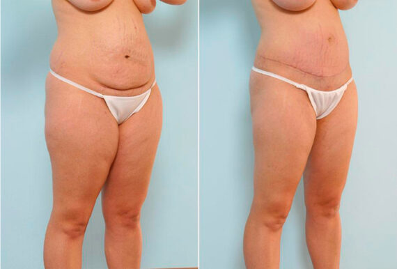 Abdominoplasty before and after photos in Houston, TX, Patient 24559