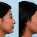 Buccal Fat Pad Removal before and after photos in Houston, TX, Patient 27817