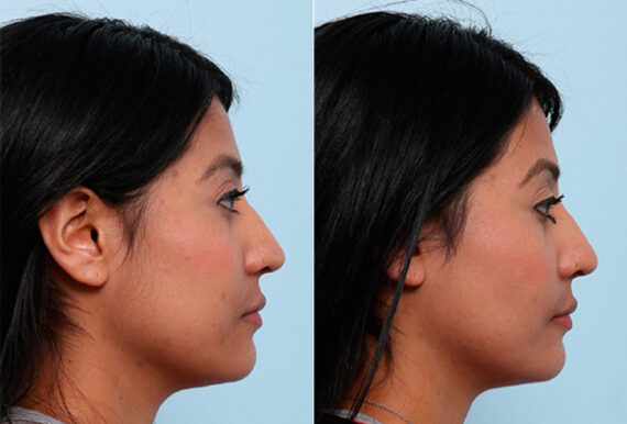 Buccal Fat Pad Removal before and after photos in Houston, TX, Patient 27817