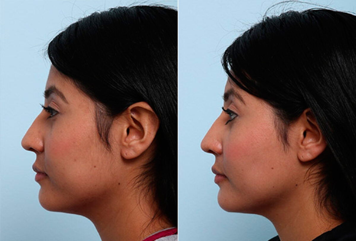 Buccal Fat Pad Removal before and after photos in Houston, TX, Patient 27817