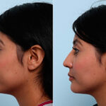 Buccal Fat Pad Removal before and after photos in Houston, TX, Patient 27817