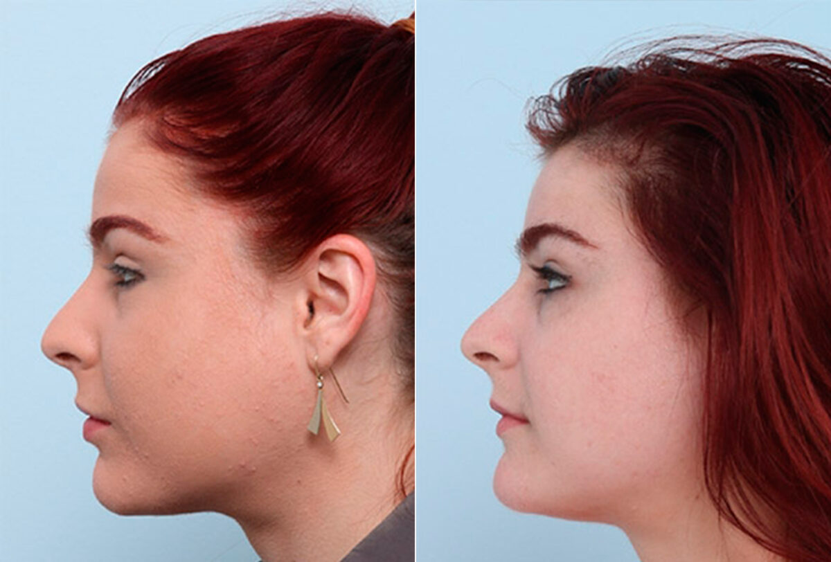 Buccal Fat Pad Removal before and after photos in Houston, TX, Patient 27824