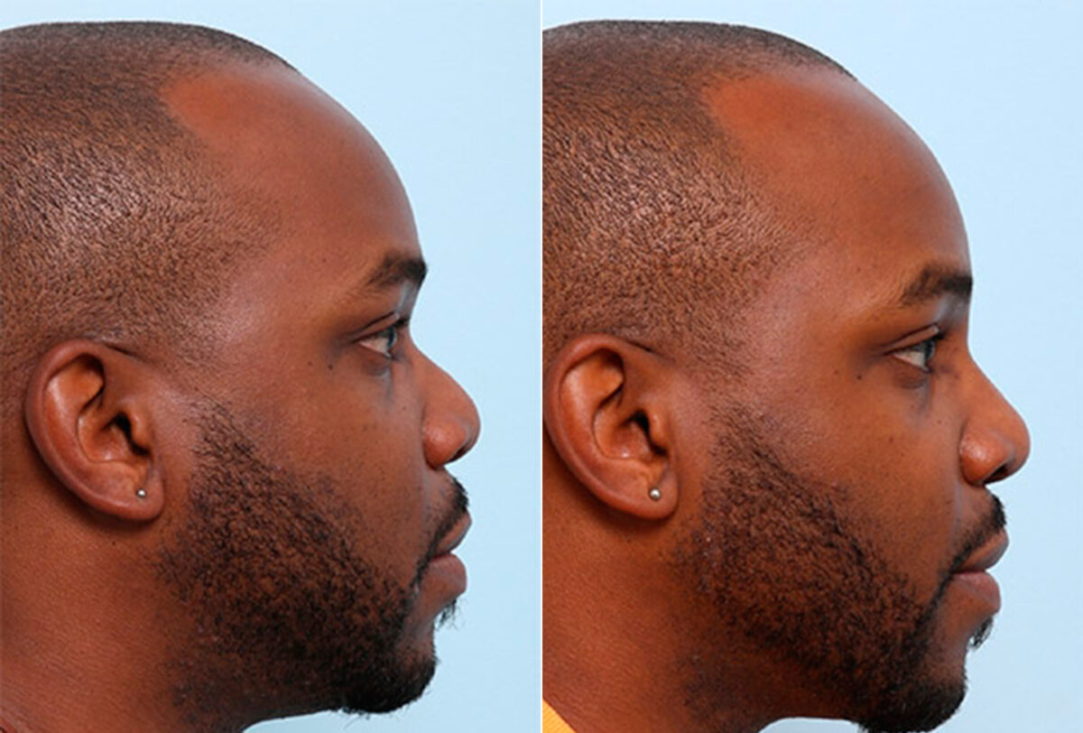 Buccal Fat Pad Removal before and after photos in Houston, TX, Patient 27838