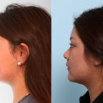 Buccal Fat Pad Removal before and after photos in Houston, TX, Patient 27845