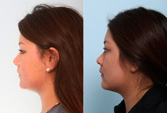 Buccal Fat Pad Removal before and after photos in Houston, TX, Patient 27845
