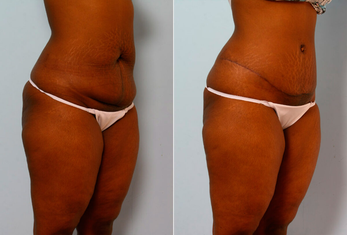Tummy Tuck/Abdominoplasty before and after photos in Houston, TX, Patient 24232