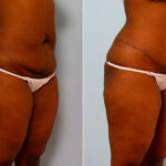 Abdominoplasty before and after photos in Houston, TX, Patient 24232